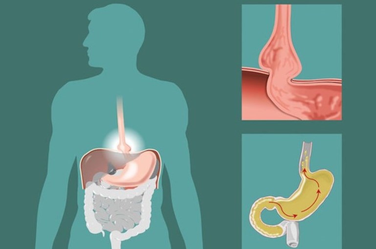 Stomach and Diaphragm Hernias